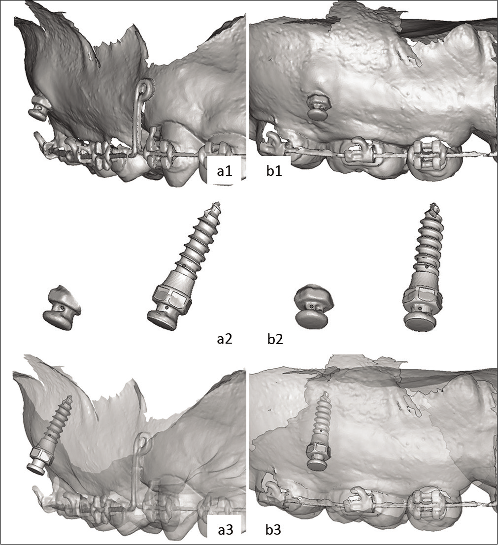 Coronal (a1) and sagittal (b1) view of post-operative digital models. The heads of the scanned miniscrews were split off and superimposed with the heads of the virtual miniscrews (a2, b2). The actual miniscrew positions were located in post-operative digital models (a3, b3).