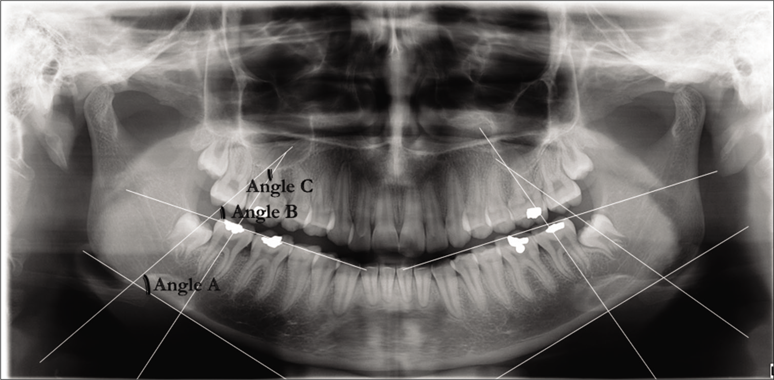 Measurements on the panoramic radiographs: third molar to base of mandible (angle A), mesioangular angulation of the third molar (angle B), third molar to second molar inclination (angle C)
