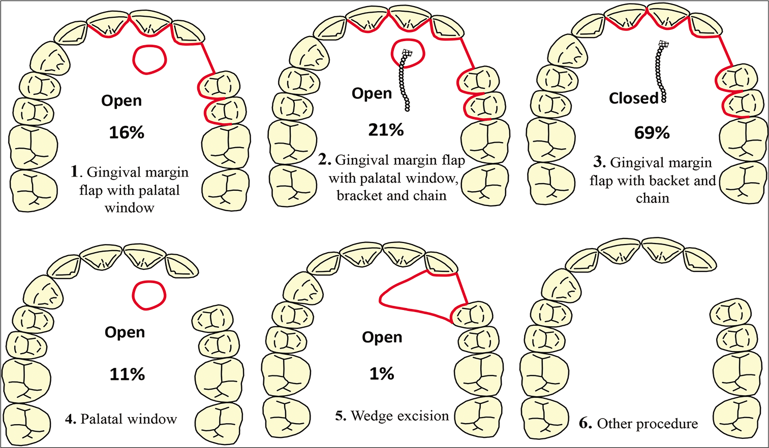 Different surgical techniques to expose palatally impacted canines. The percentage below each image indicates how often a certain technique was selected by the respondents.