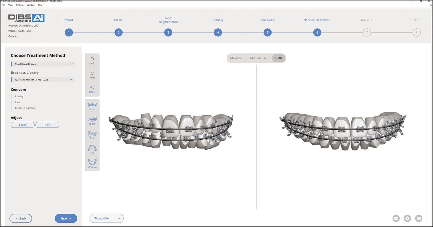 Indirect bracketing using artificial intelligence.