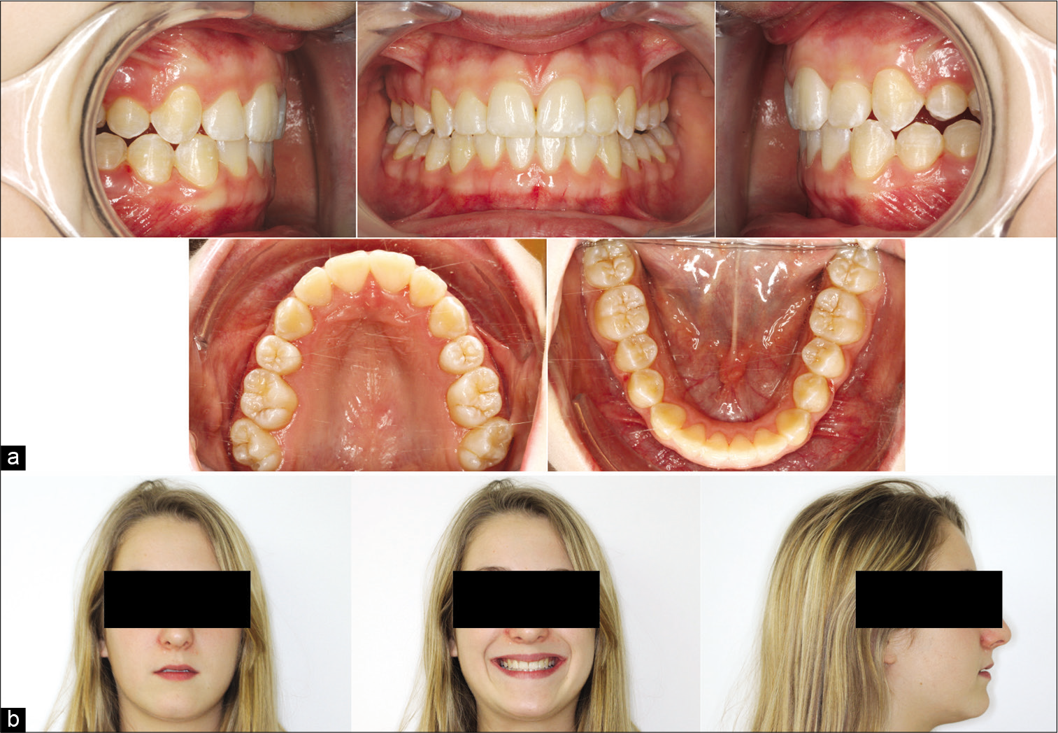 (a) Intra- and (b) extraoral photographs after the alignment stage.