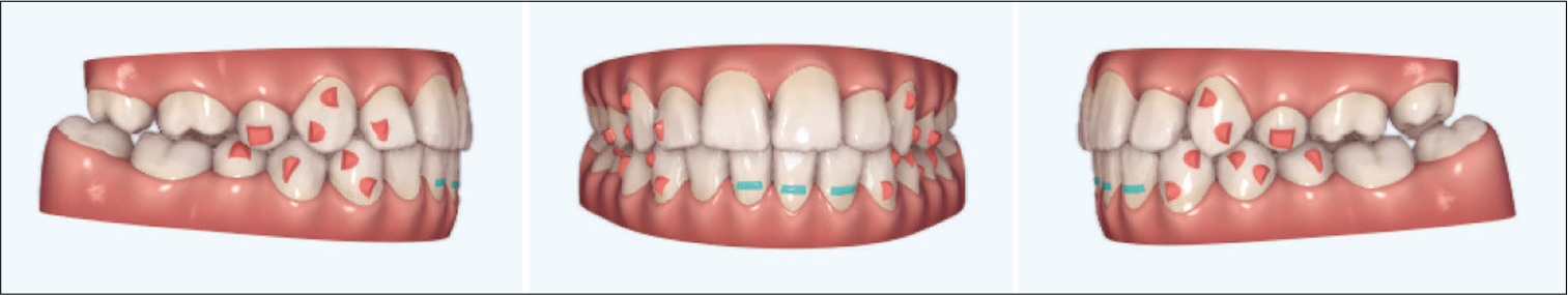 ClinCheck treatment plan for the refinement stage. Red squares represent attachments and blue lines represent Power Ridges.