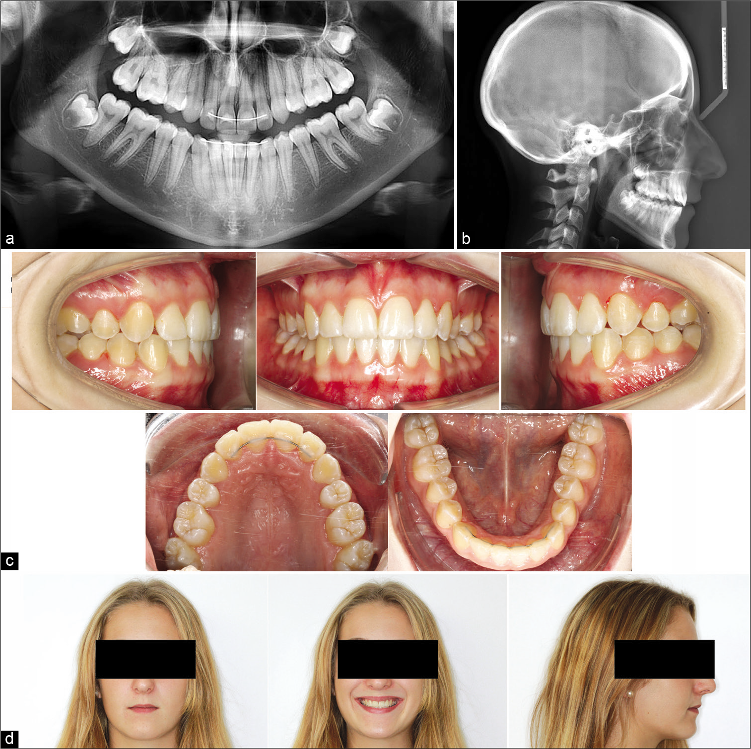 Clinical examination of the post-treatment dental status. Post-treatment (a) panoramic radiograph, (b) lateral cephalogram, (c) intraoral photographs, and (d) extraoral photographs of the facial profile.