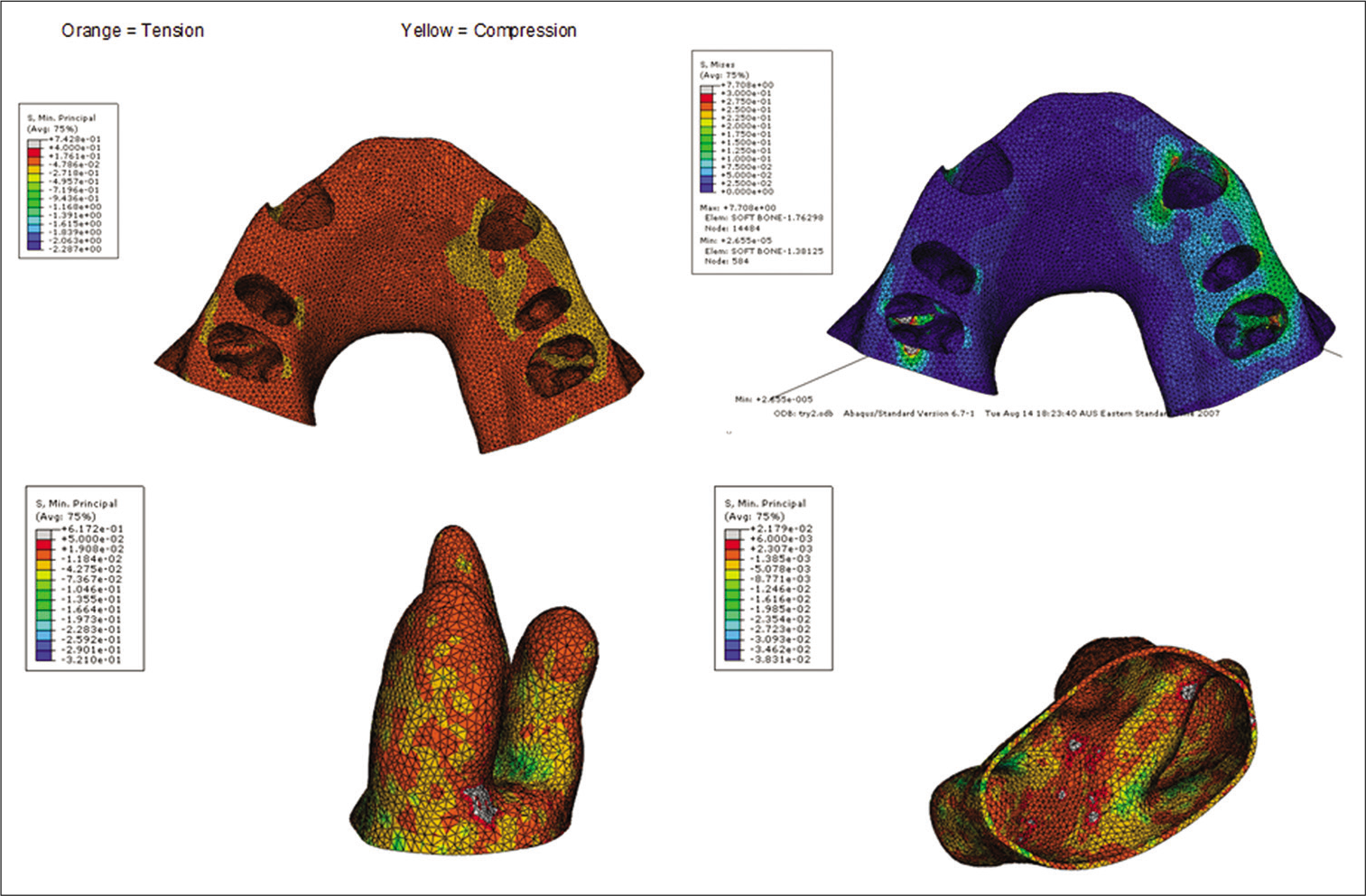 A three-dimensional finite element model aimed to explore the biomechanical response of the periodontal ligament [first principal (tensile) and third principal (compressive) stresses] and maxillary alveolar bone (von Mises stress) under purported “heavy” (300 g) and “light” (50 g) continuous orthodontic forces. The study highlights that stress within the periodontium can occur with both heavy and light orthodontic forces.