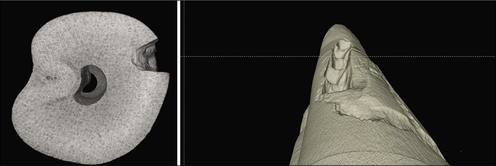 Images showing micro-CT piezocision study showing risk of iatrogenic damage when piezocision is applied close to the roots.