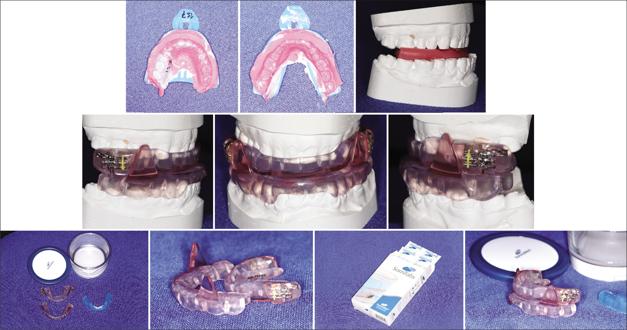 A bite registration is made for the fabrication of mandibular advancement splint (MAS). The MAS, like SomnoMed (SomnoMed, SomnoDent MAS; SomnoMed Ltd, Crows Nest, Australia), is convenient to adjust as it is fitted with an adjustment screw that aids the patient to locate the best possible jaw position to control the symptoms of obstructive sleep apnea.