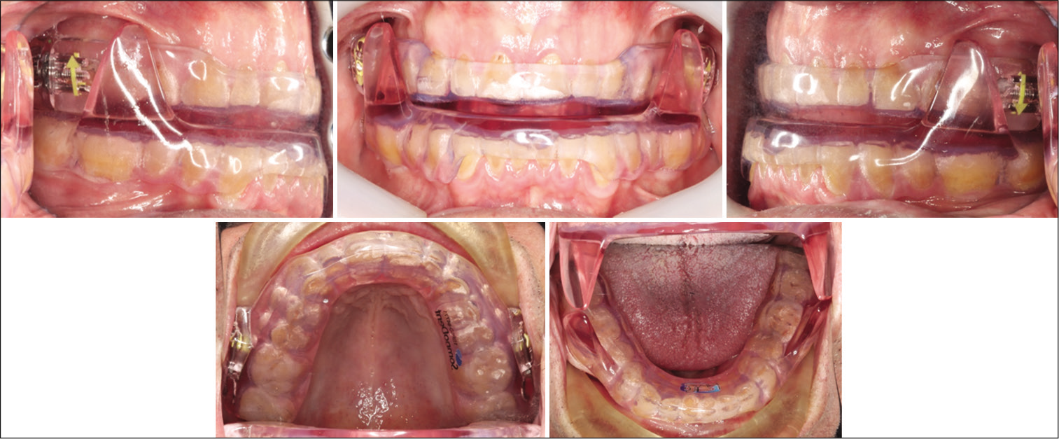 Mandibular advancement splints fitted in an obstructive sleep apnea patient.