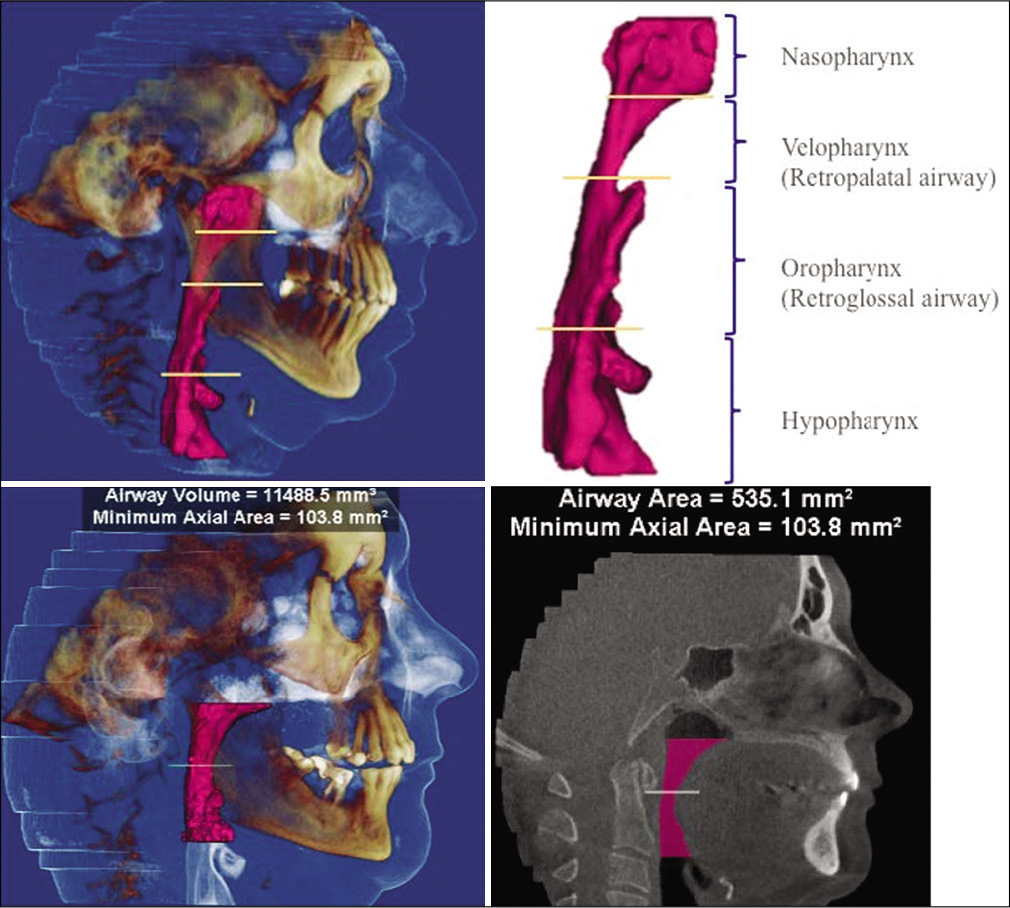 Cone beam CT images of pharyngeal airway space studied in the responders and non-responders to mandibular advancement splints treatment.