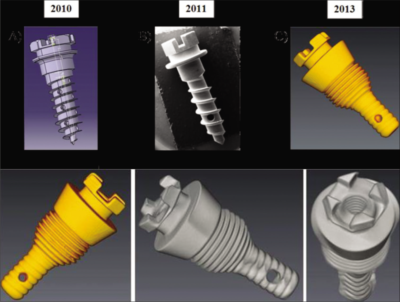 The Sydney Mini Screw (SMS, Patent number: PCT2009014). The initial implant design introduced in 2010, the SMS has seen several refinements with the current design having a dispersion capacity of an injectable bone graft.