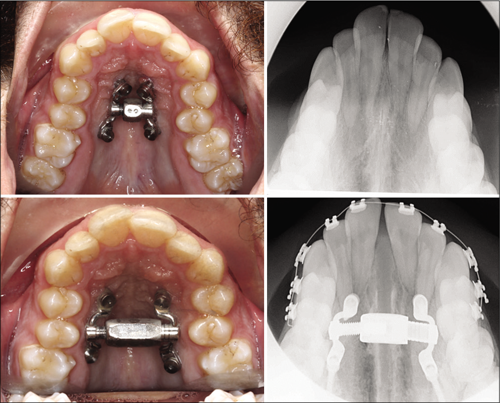 Miniscrew-assisted rapid palatal expander could be an alternate for those individuals that do not prefer surgical intervention or is contraindicated for the correction of constricted maxillary arch.