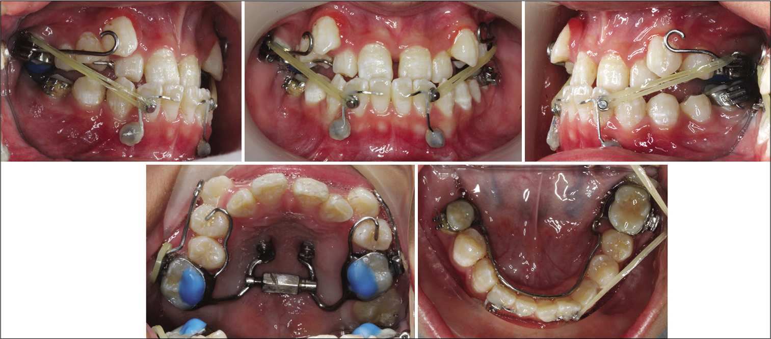 Intraoral images showing miniscrew-assisted rapid palatal expander with alternating rapid maxillary expansion and constriction protocol (9 weeks) used in conjunction with heavy Class III elastics in the management of Class III malocclusion.