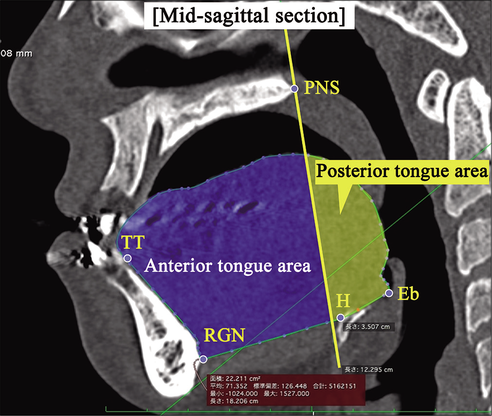 Measurements of tongue cross-sectional area. TT: Tongue tip, RGN: A perpendicular line from the FH plane and symphysis where the mandibular symphysis intersects the most posterior point, H: The front most point of the hyoid bone, Eb: Epiglottis base; the lowest point in the epiglottis.