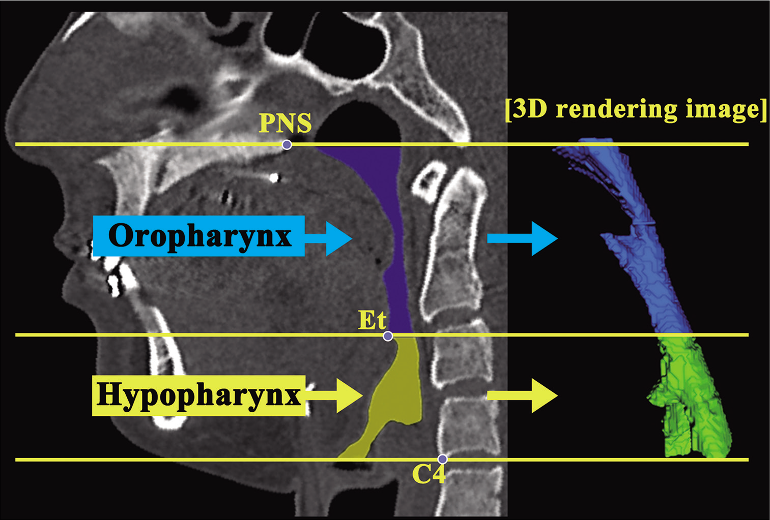 An example of a three-dimensional image of the upper airway, oropharynx, and hypopharynx.