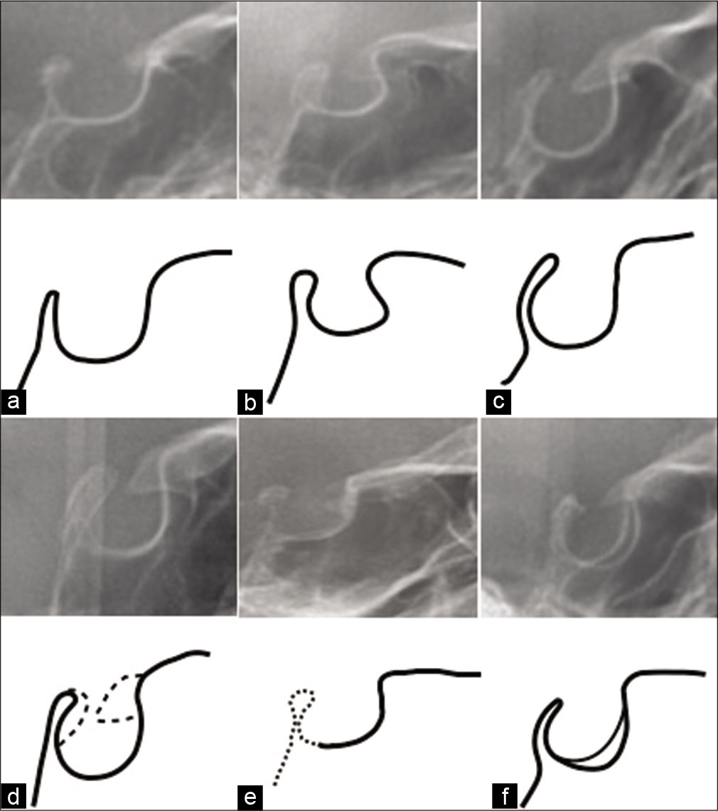 Drawing and detailing of different morphological forms of sella turcica on cephalometric radiographs (a) normal sella turcica, (b) oblique anterior wall of the sella turcica, (c) pyramidal shape of sella turcica, (d) sella turcica bridge, (e) irregularity of the posterior wall of the sella turcica, (f) double counter of the sella turcica floor.