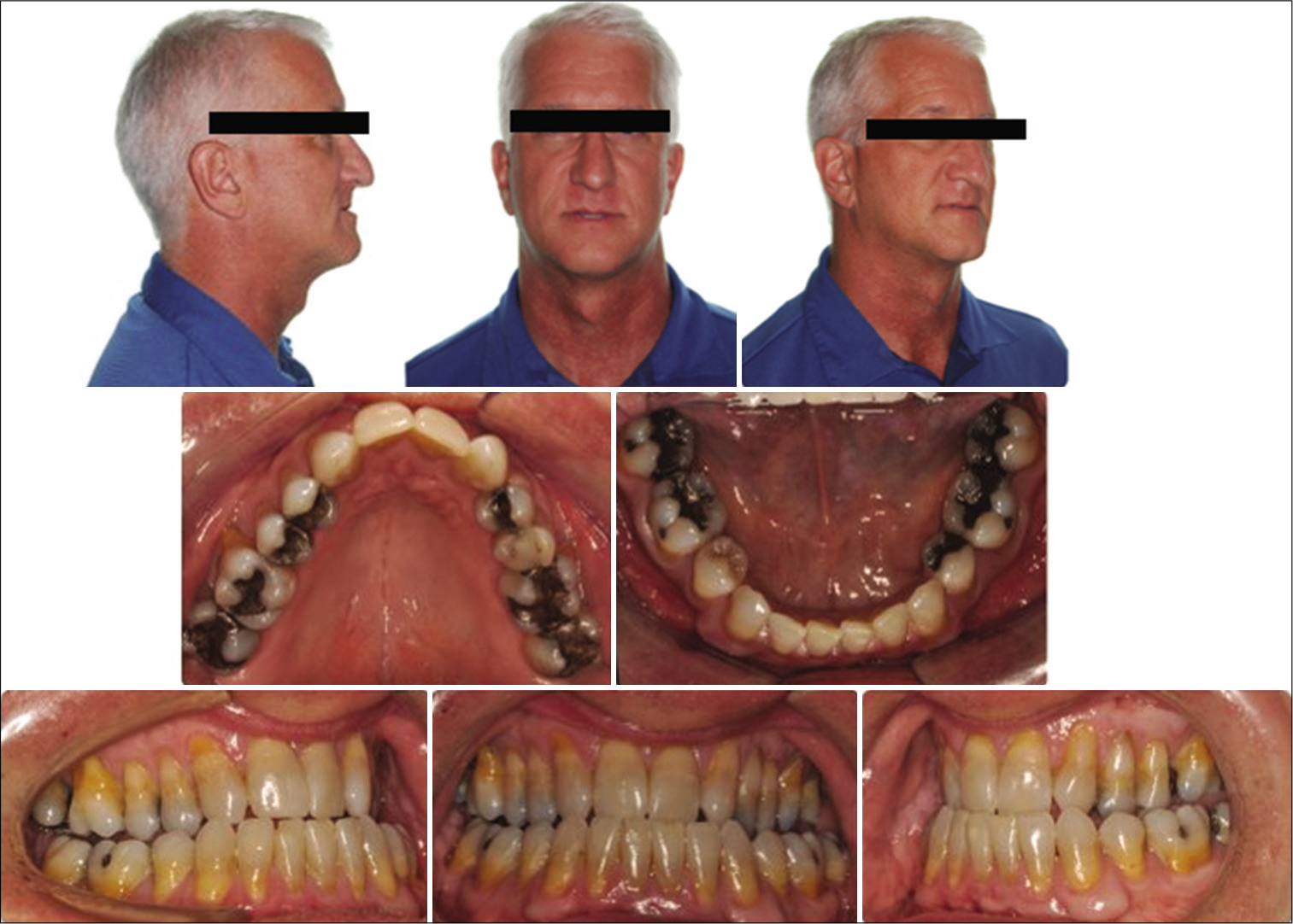 Pre-treatment extra- and intra-oral photos.