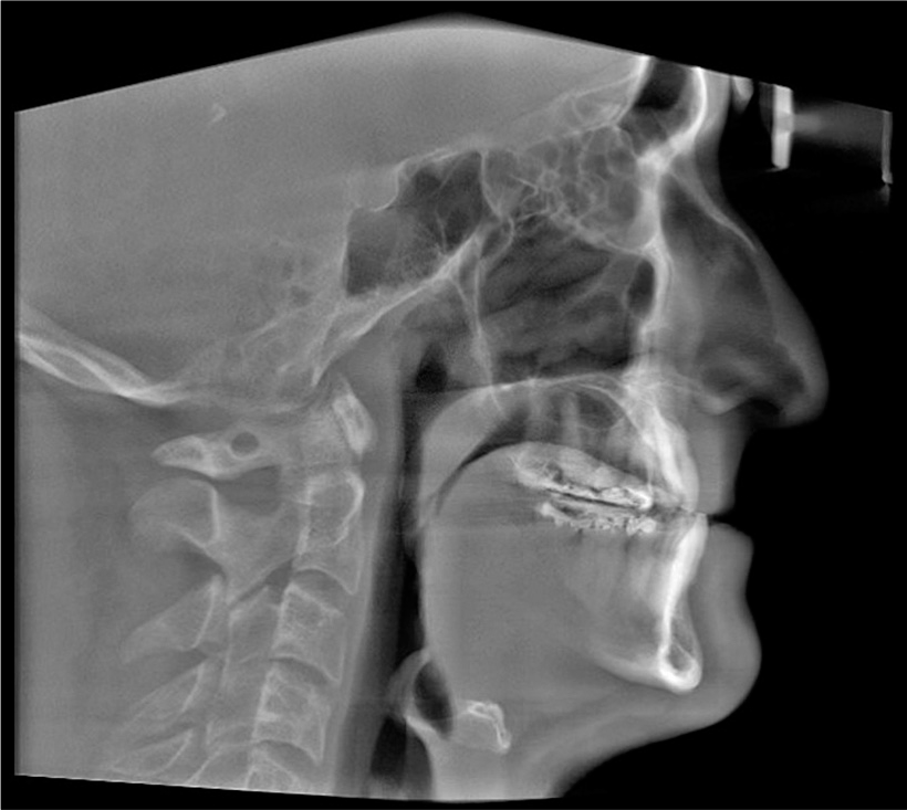 Pre-treatment cephalometric X-ray.