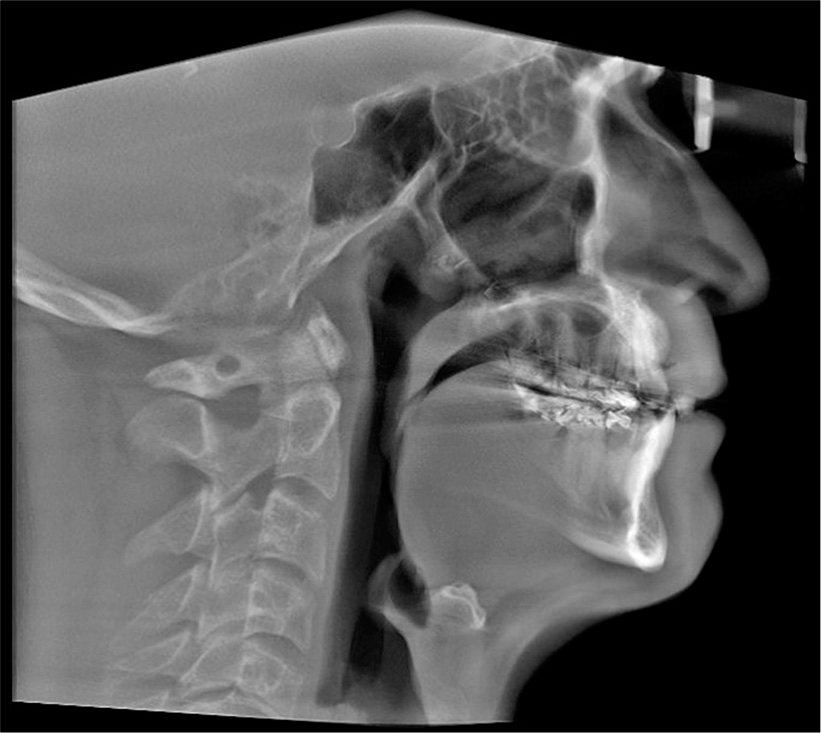 Post-treatment cephalometric X-ray.
