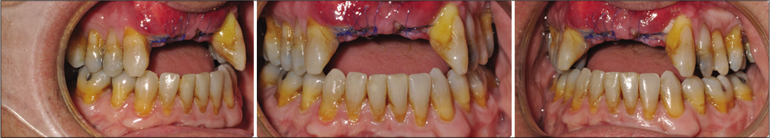 Post-surgical intraoral photos.