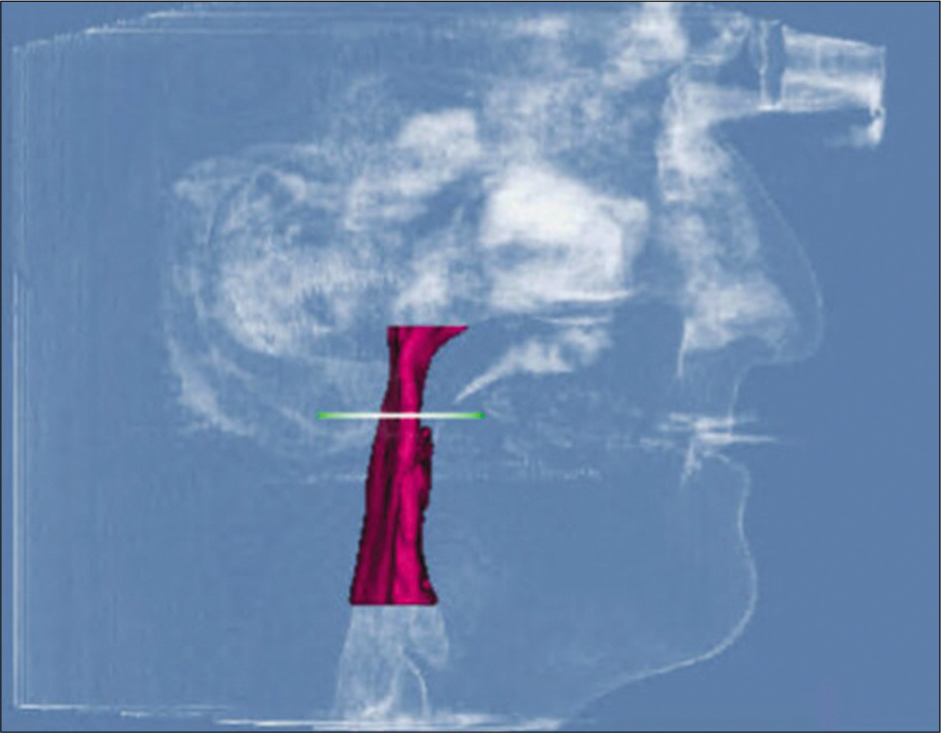 Pre-treatment airway measurements.