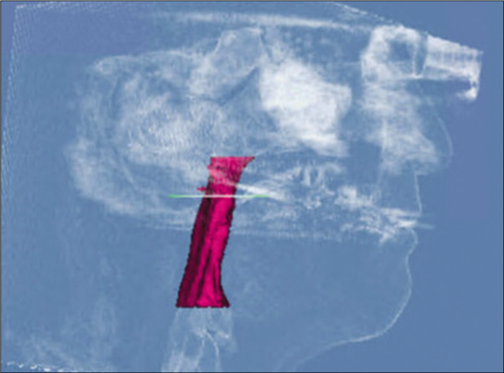 Post-treatment airway measurements.