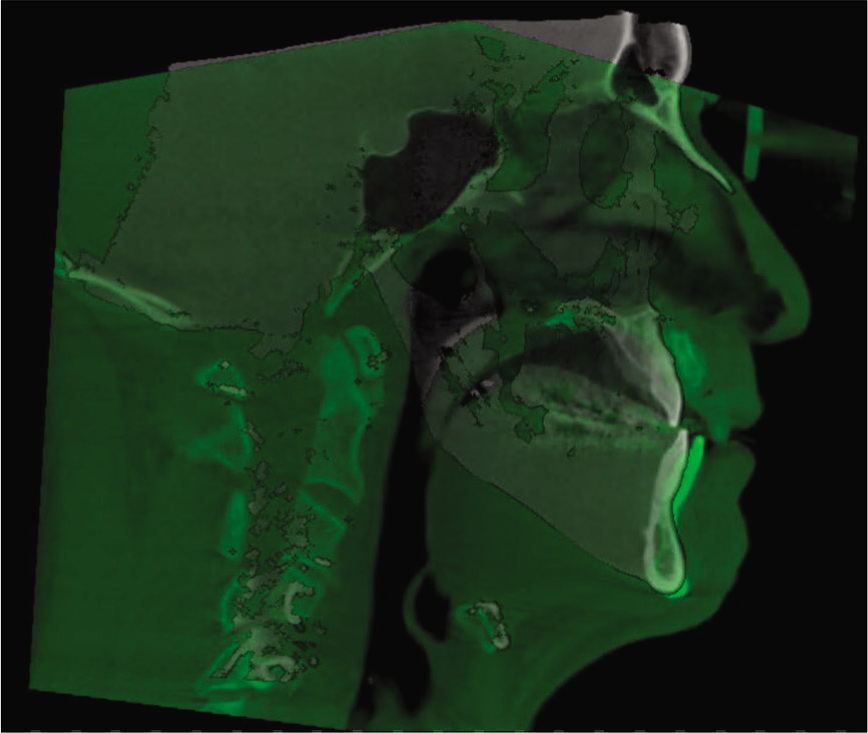 3D skeletal superimposition.