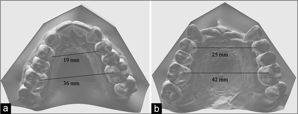 (a) Pre-treatment, (b) post-treatment upper models.