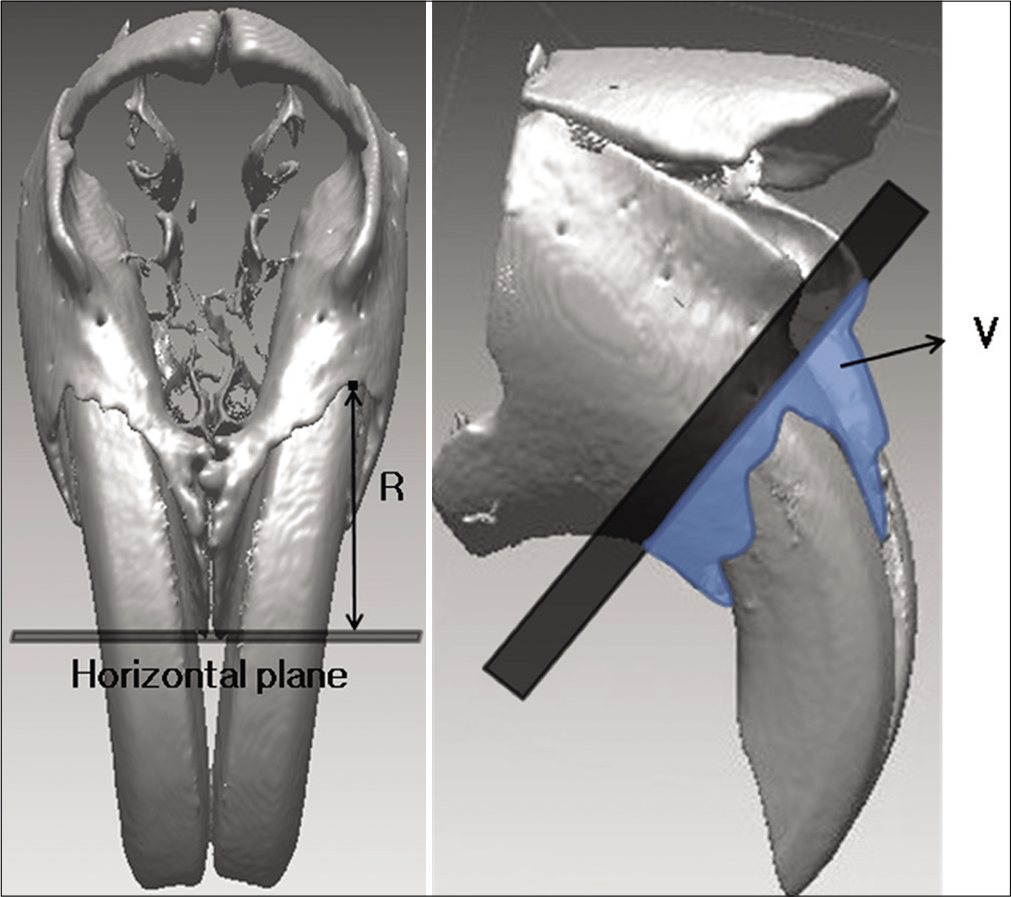 Measurements for alveolar bone change. R, the perpendicular distance of incisive superior alveolar point to the horizontal plane; V, the volume of bone below the reference plane for ROI.
