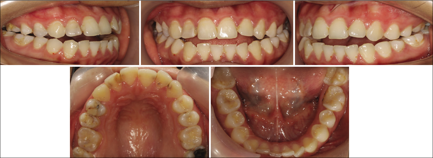 Initial intraoral photographs showing patient with anterior open bite and posterior cross bites.