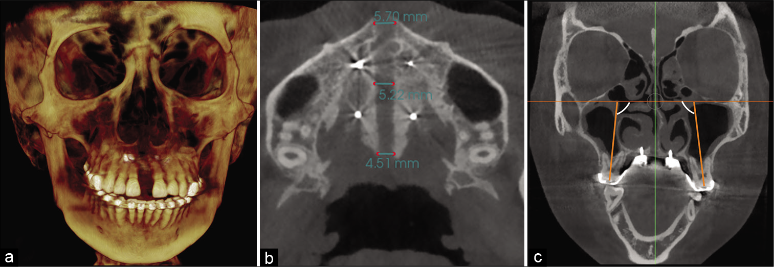 Final frontal (a) and axial (b) Cone-beam computed tomography (CBCT) slices showing homogenous suture opening along the anterior and posterior regions and uniform separation of the hemimaxillae. (c) Frontal CBCT slice showing buccal tipping of posterior molar after maxillary expansion.
