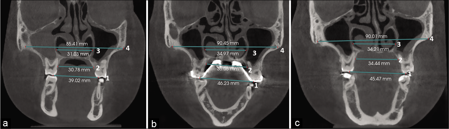 Dental and skeletal linear measurements in the coronal zygomatic section: Maxillary width was measured at the level of intermolar distance (1), at the inferior palatine margin of alveolar process of maxilla (2), at the level of nasal floor (3), and maxillary width at the lower interzygomatic distance (4) in the pretreatment (a), directly after expansion (b), and after 20 months of retention (c).