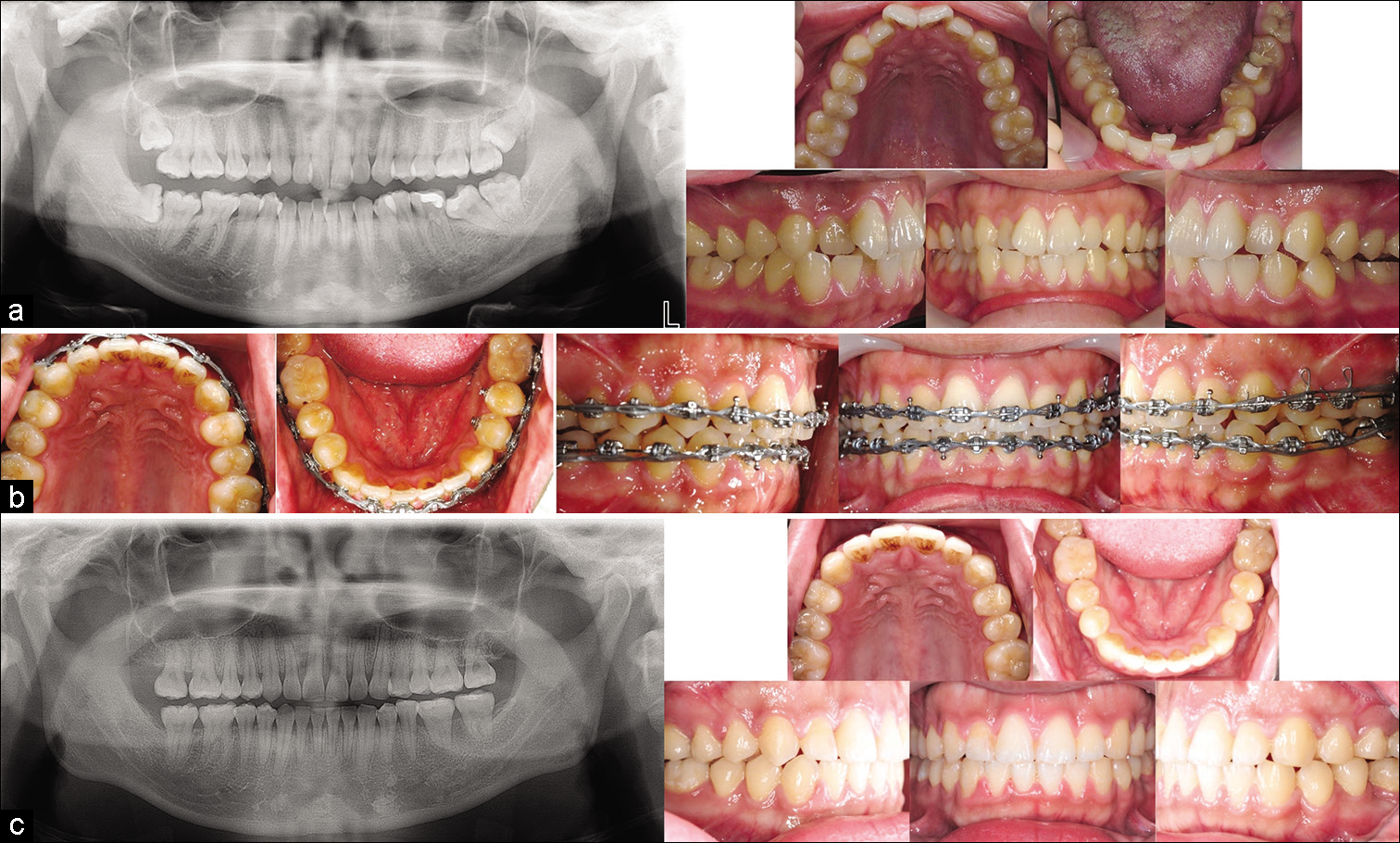 Case 1: (a) Initial records; (b) Mid-treatment records, metal brackets (Ormco, CA, USA) with 0.018-in slots for the anterior teeth and 0.022-in slots for the posterior teeth. The initial wires were 0.016-in NiTi and 0.016 × 0.022-in NiTi, the working wire was 0.016 × 0.022- in SS, and the finishing wire was 0.017 × 0.025-in TMA; (c) Post-treatment records.