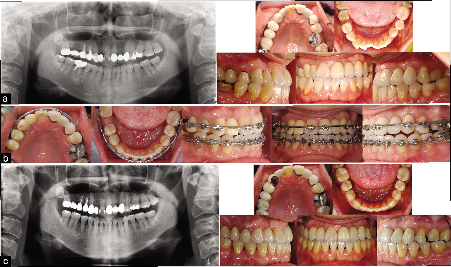 Case 2: (a) Initial records; (b) Mid-treatment records, metal brackets (Ormco, CA, USA) with 0.018-in slots for the anterior teeth and 0.022-in slots for the posterior teeth. The initial wires were 0.016-in NiTi and 0.016 × 0.022-in NiTi, the working wire was 0.016 × 0.022- in SS, and the finishing wire was 0.017 × 0.025-in TMA; (c) Post-treatment records.