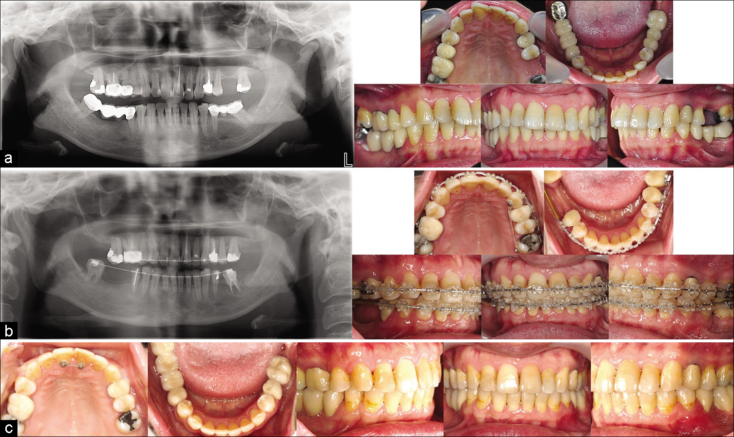 Case 3: (a) Initial records; (b) Mid-treatment records, clear brackets (Tomy, Tokyo, Japan) with 0.018-in slots for the anterior teeth and 0.022-in slots for the posterior teeth. The initial wires were 0.016-in NiTi and 0.016 × 0.022-in NiTi, the working wire was 0.016 × 0.022- in SS, and the finishing wire was 0.017 × 0.025-in TMA; (c) Post-treatment records.