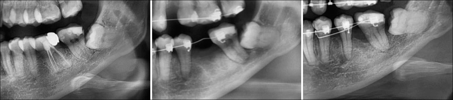 A vertical bony defect was found at the mesial root of the mandibular left second molar after the protraction.
