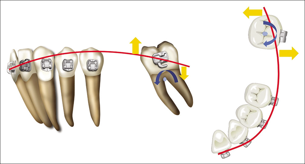 The toe-in bend prevents mesial rotation and buccal sweeping of the mandibular second molar: Blue arrows, moments generated by the protracting forces; yellow arrows, couples designed to counteract the moments.