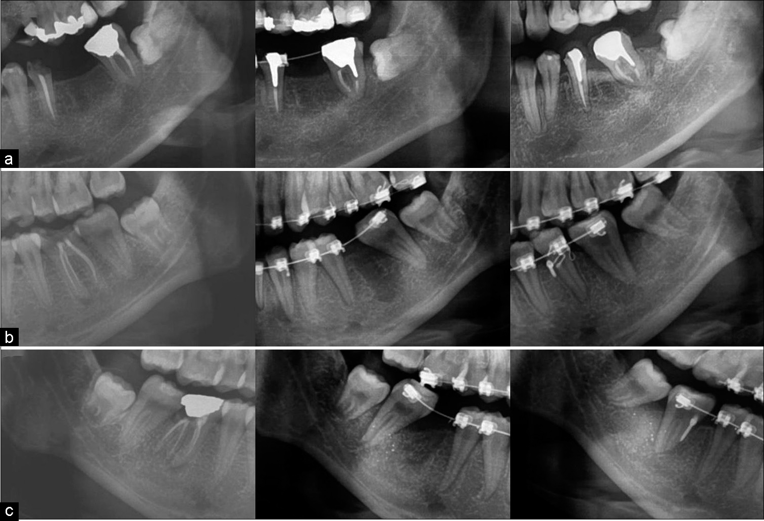 (a) No spontaneous eruption of the horizontally impacted third molar after second molar protraction. (b and c) Spontaneous eruption of the vertically impacted third molar.