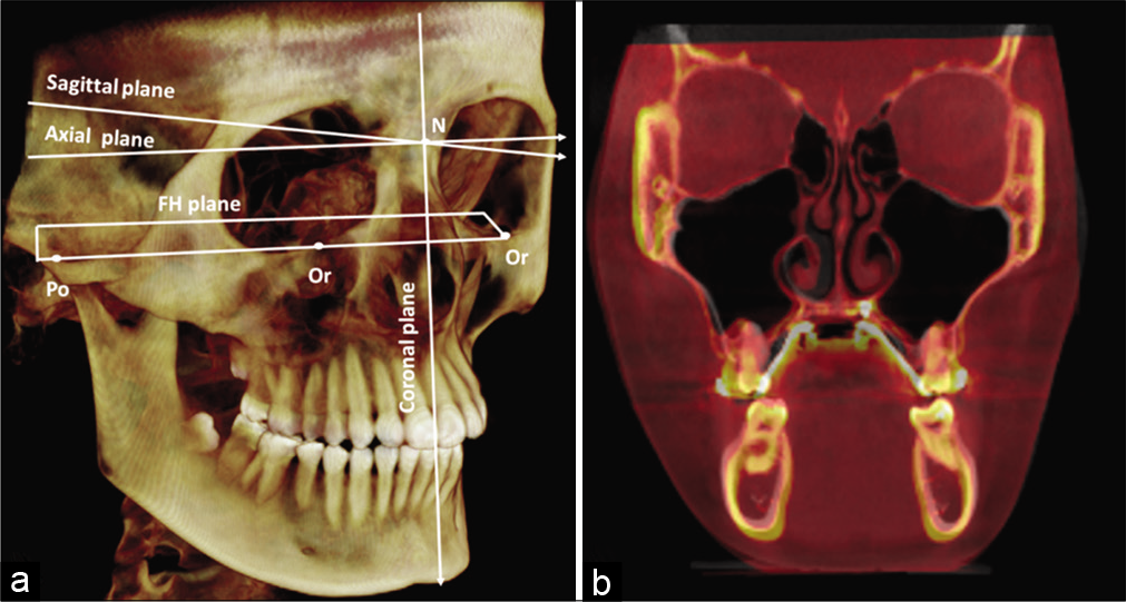 (a) Lateral view of 3D rendering coordinated by three reference planes with zero point (0, 0, and 0) at the nasion. (b) Pre-treatment and post-treatment superimposed image of a MARPE patient.