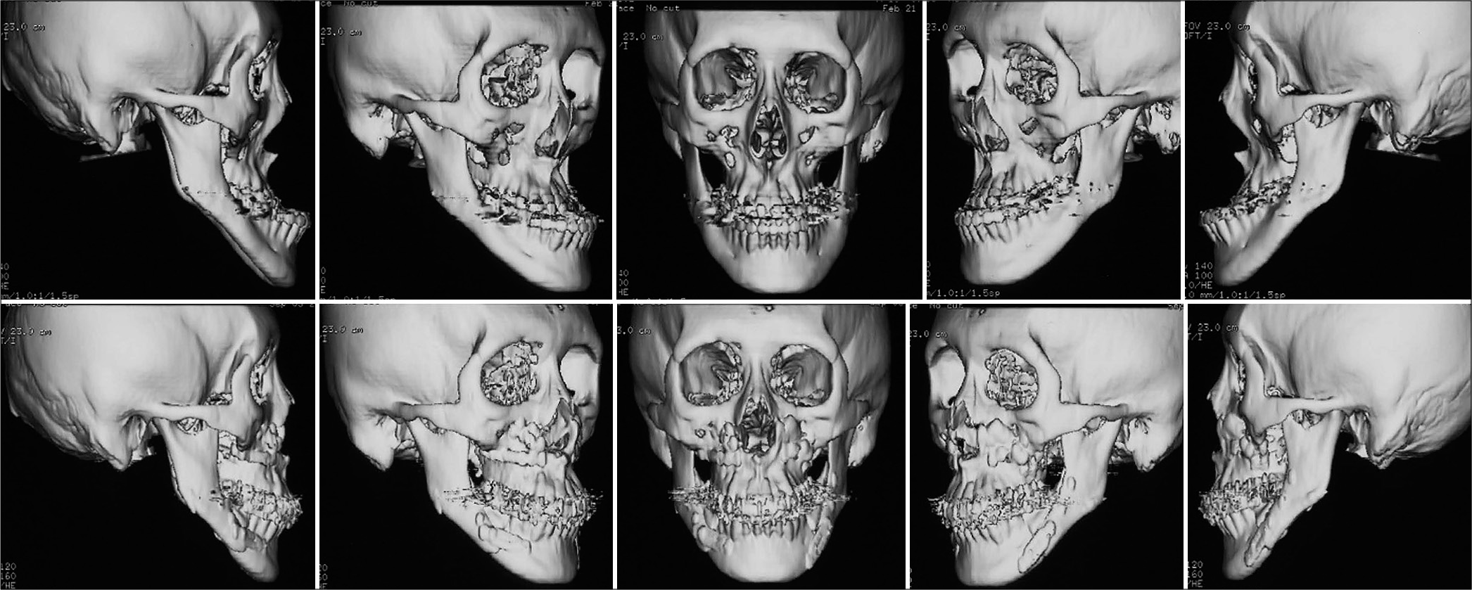 Presurgery (upper) and Posttreatment (lower) 3D images of CT radiographs.