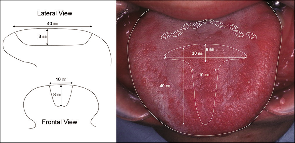 Scheme of tongue reduction. Illustration demonstrating the incisions for the tongue partial reduction. Dotted lines represent the excised portion of the tongue.