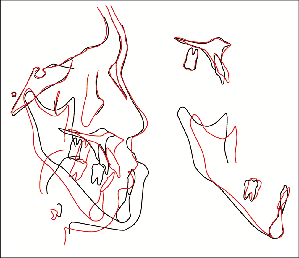 Superimposition of pretreatment and posttreatment cephalometric tracings. The lower first molar is traced in the pretreatment and the second molar is traced in the posttreatment.