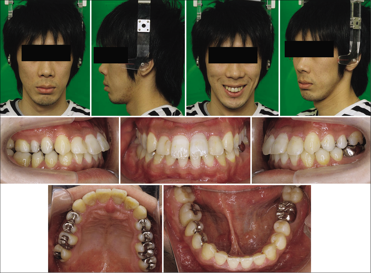 Facial and intraoral photographs 3 years after retention.