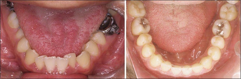 Comparison of the tongue size pretreatment (left) and posttreatment (right).