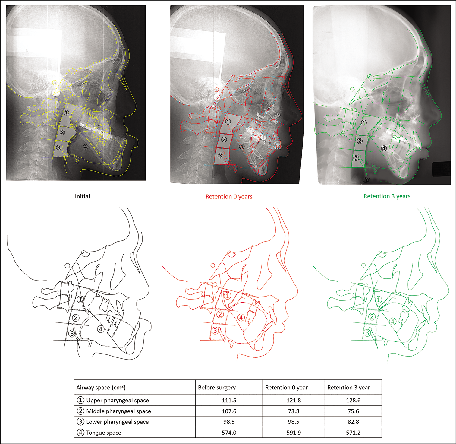 Changes in the upper airway area. Initial (yellow), at deband (red) and 3 years post-retention (green). (1) Upper pharyngeal space the pharyngeal space between the lines of PNS to the apex dentis of axis and the lower faces of axis articulares to uvula. (2) Middle pharyngeal space; the pharyngeal space between the lines of the lower faces of axis articulares to uvula and the lower face of the third vertebrae cervicales. (3) Lower pharyngeal space between the lines of the lower face of the third vertebrae cervicales and the lower face of the fourth vertebrae cervicales to hyoid bone.