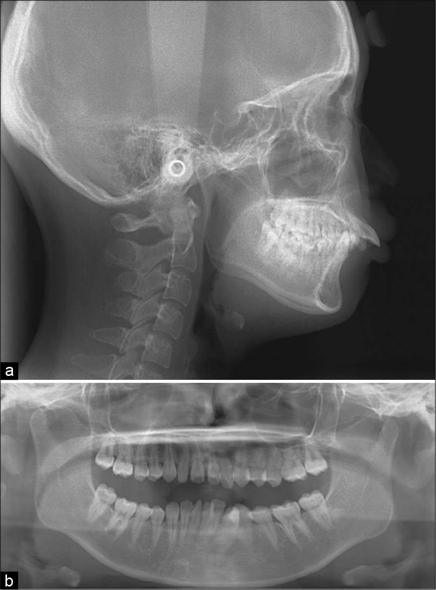 (a-b) Pre-treatment lateral cephalogram. Proclined anterior maxillary teeth and lip protrusion before surgery. Pretreatment panoramic radiographs. Non-concurrent tooth axis and crowding in the anterior mandibular teeth. No abnormalities in the temporomandibular joint.