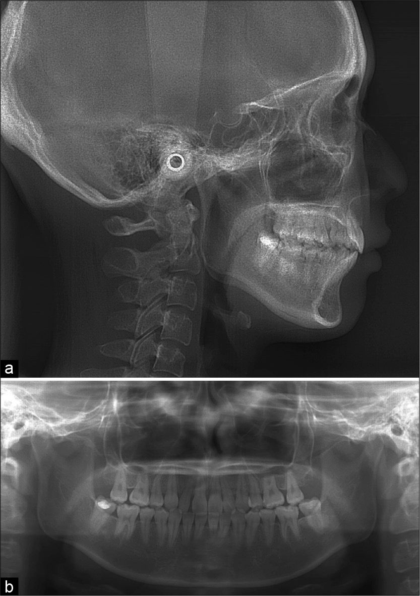 (a) Post-treatment lateral cephalograms and (b) post-treatment panoramic radiographs. The tooth axes are well-aligned, and parallelism of the roots is evident. The treatment successfully completed without root resorption.