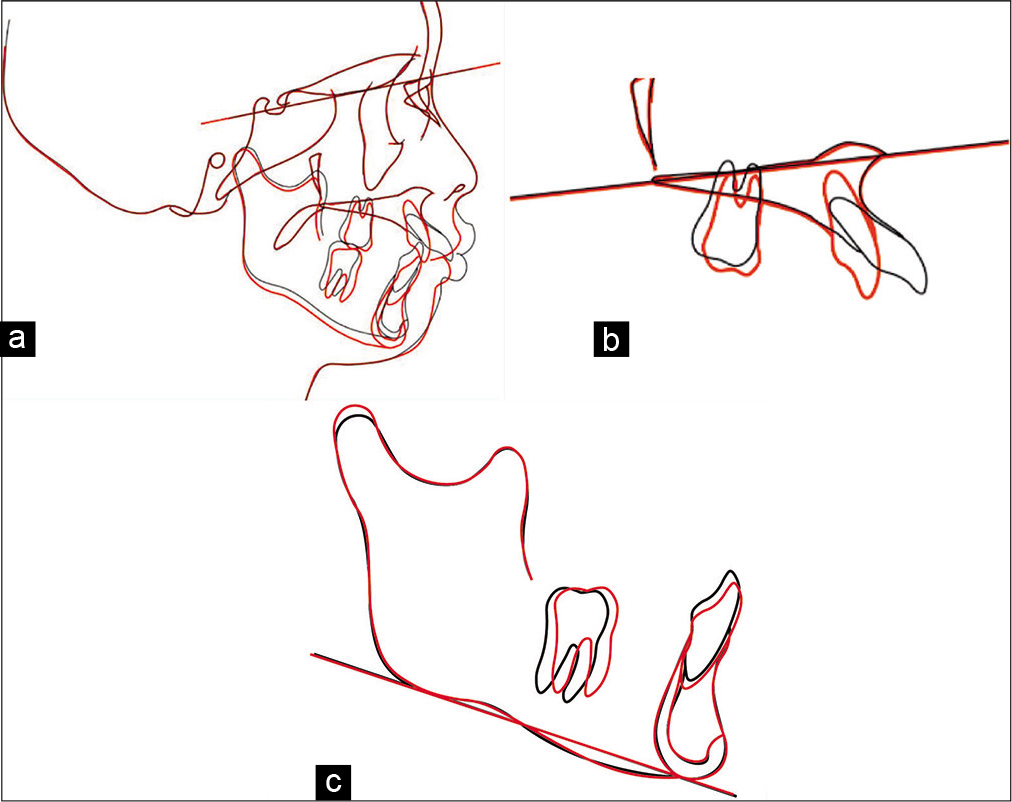 Cephalometry showing superimposition of the pretreatment (black line) and post-treatment planes (red line). (a) On the sella-G-nasion plane at the sella. (b) On the palatal at the ANS. (c) On the mandibular plane at the mention. Posterior movement of the maxillary anterior teeth was achieved successfully.
