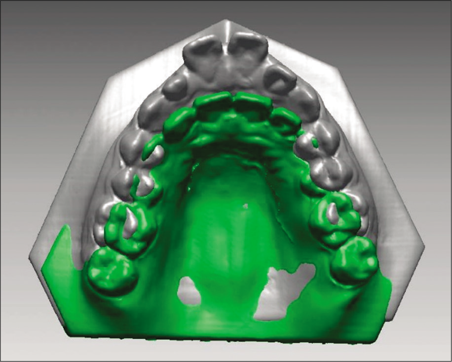 Superimposed three-dimensional teeth model data. Gray represents the pretreatment data and the green represents the post-treatment data. The superposition of the molars showed that the anterior teeth had been retracted significantly after treatment.