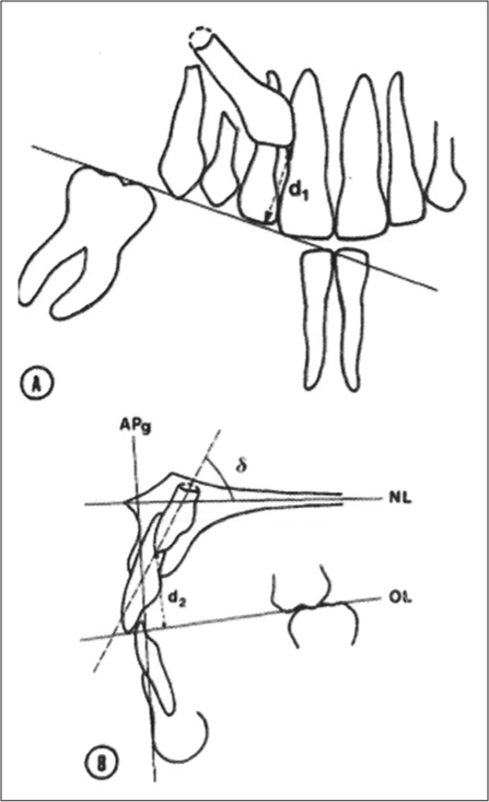 Evaluation of a correlation between the severity of root resorption of ...