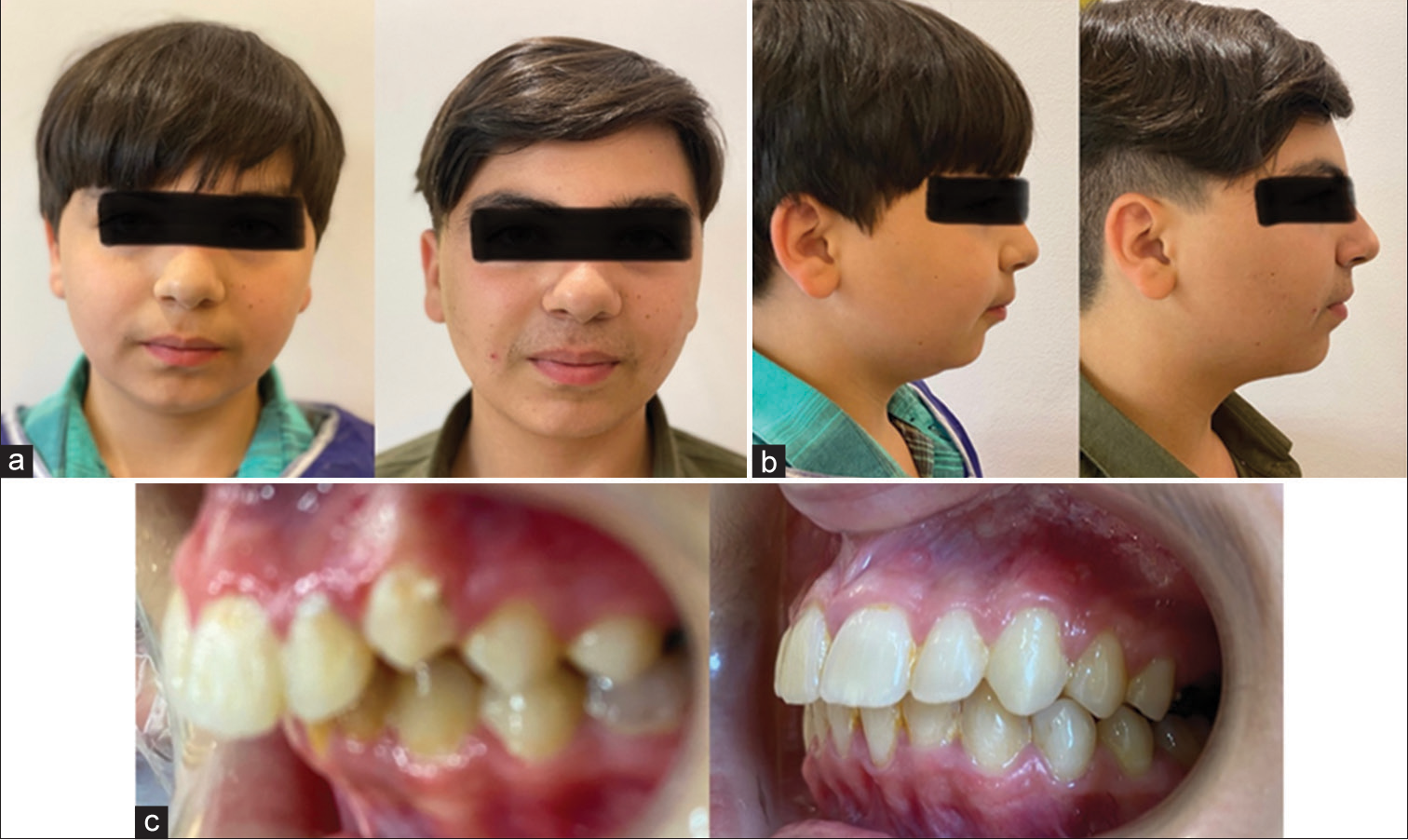 Pre- and post-treatment photographs: (a) frontal view, (b) profile view, and (c) lateral view intraoral.