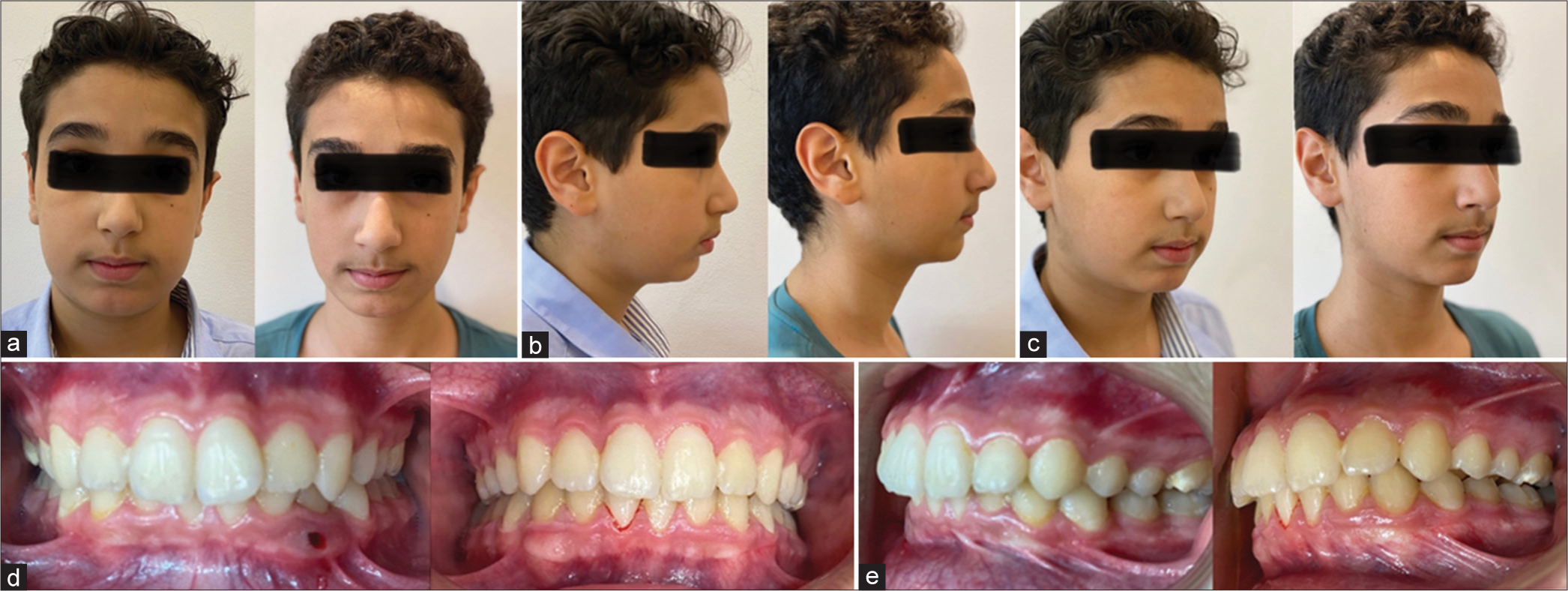 Pre- and post-treatment photographs: (a) frontal view, (b) profile view, (c) oblique view, (d) intraoral view, and (e) lateral view of intraoral.